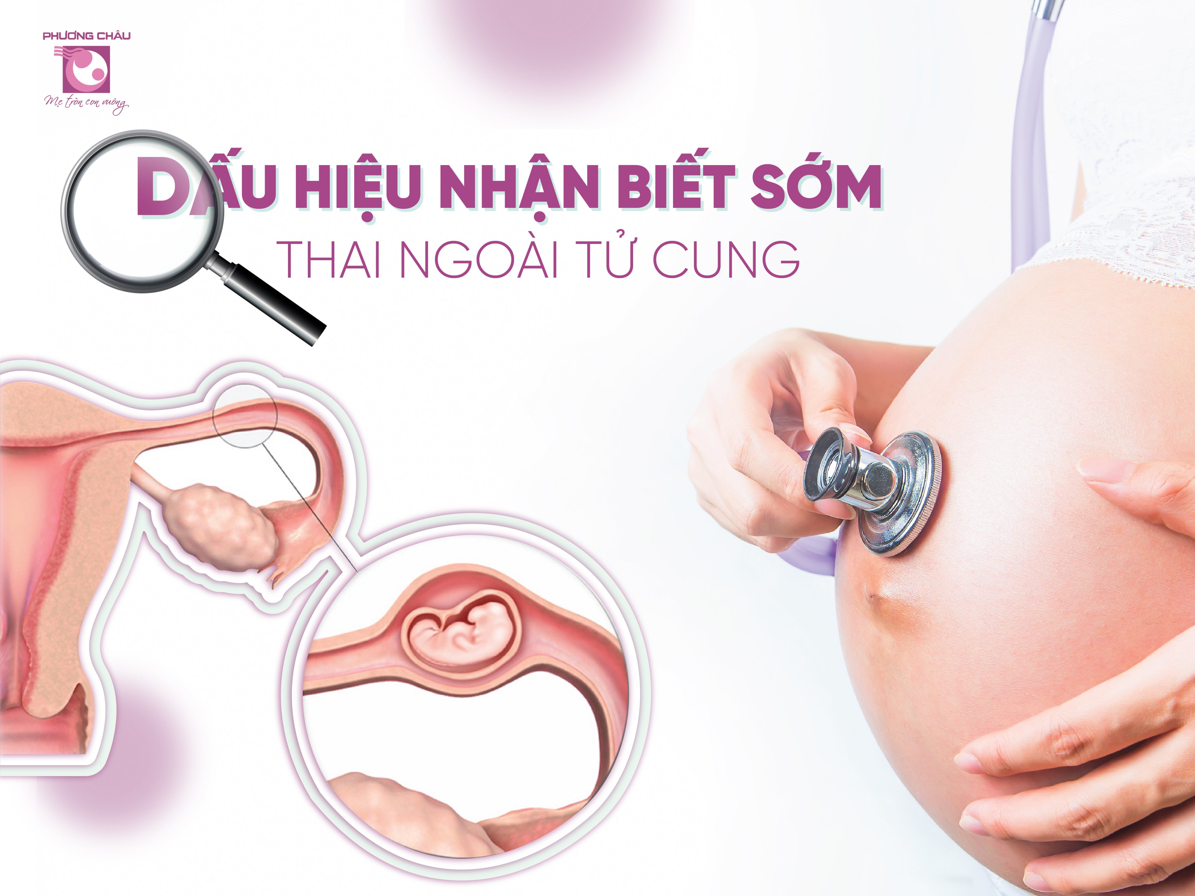 thai ngoài tử cung, chửa ngoài dạ con, dấu hiệu nhận biết, thai ngoài, sớm, tử cung, khám thai
