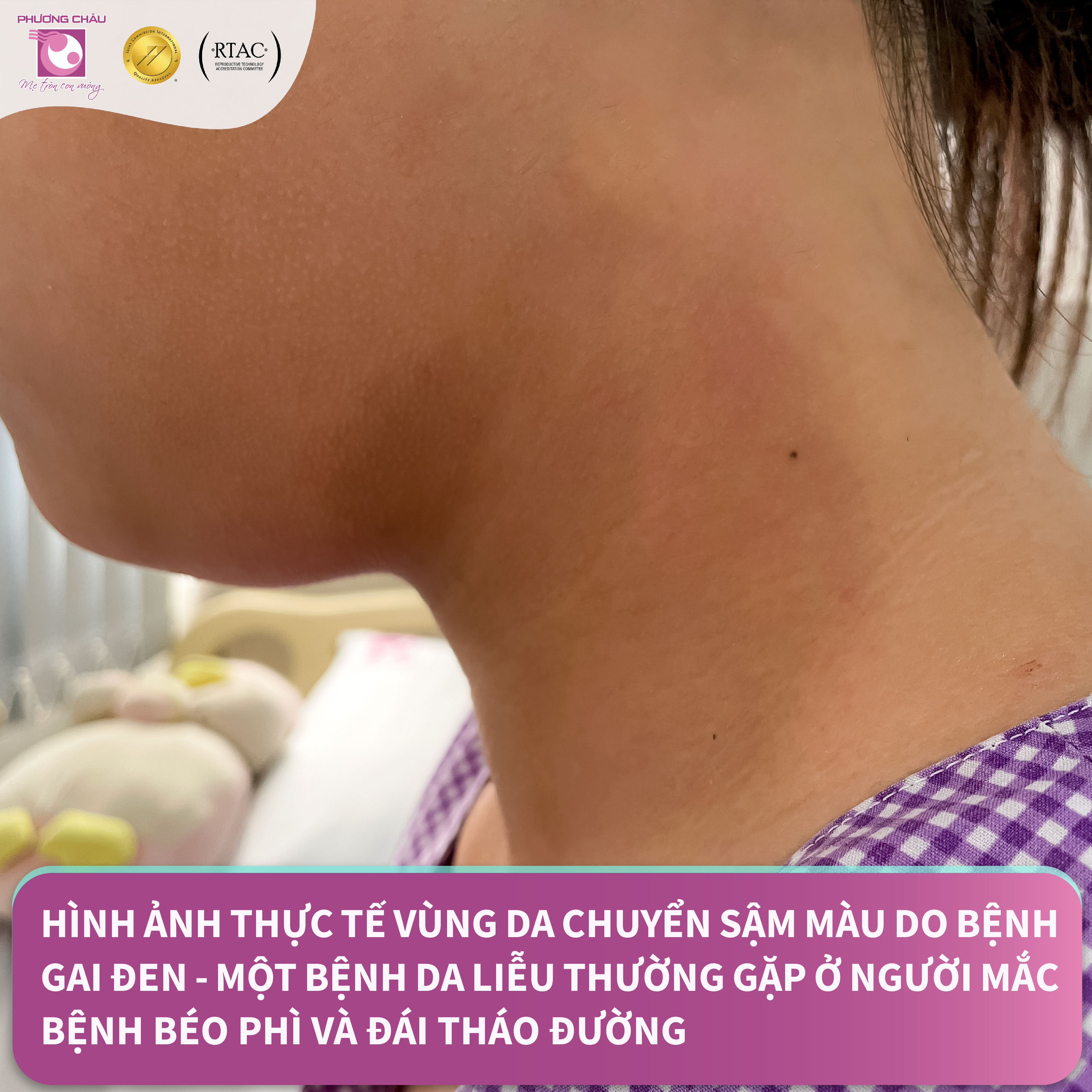Trung tâm Nội tiết, BVQT Phương Châu có tiếp nhận bé gái chỉ mới 13 tuổi đến khám và phát hiện mắc đái tháo đường type 2.