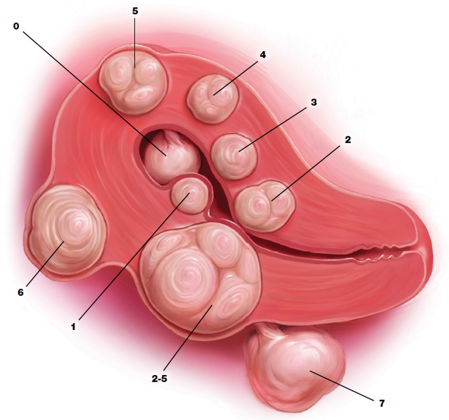U xơ tử cung hay lạc nội mạc trong cơ tử cung là 2 loại bệnh lý thường gặp đối với chị em phụ nữ, hãy cùng Phương Châu tìm hiểu phương pháp Đốt u xơ tử cung bằng sóng cao tần rfa qua bài viết sau nhé