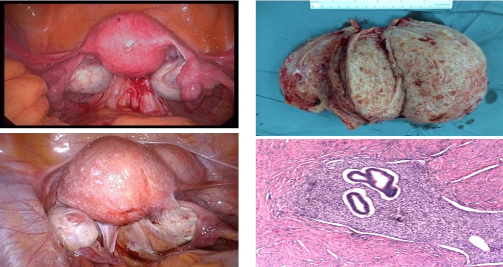 Hình 1: Tử cung bị lạc nội mạc trong cơ tử cung (Adenomyosis)