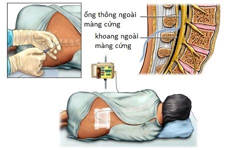 Hình ảnh minh họa cách thức thực hiện gây tê màng cứng