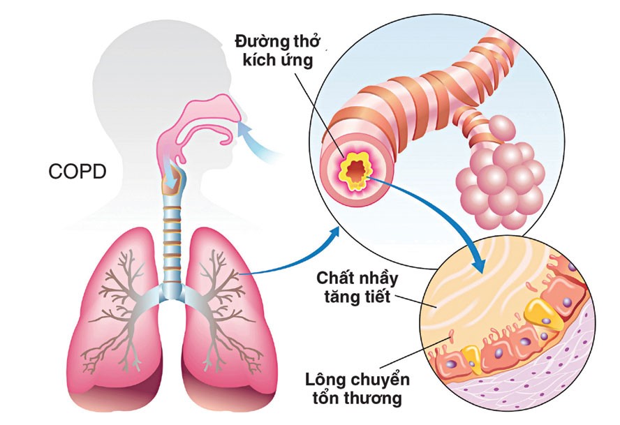 Hình ảnh niêm mạc đường thở tổn thương do COPD