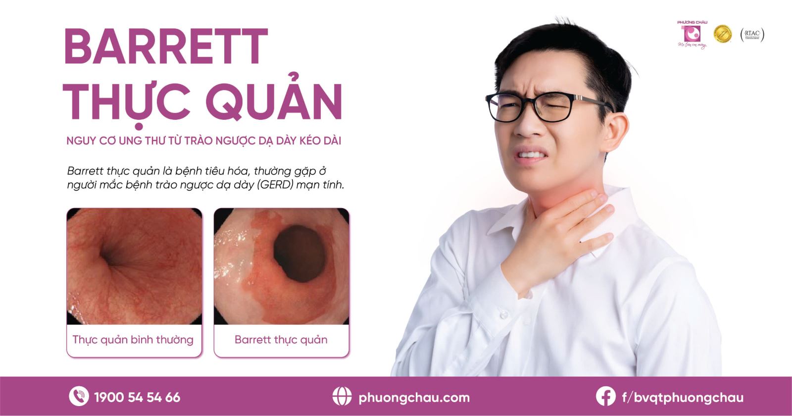 Bệnh Barrett thực quản thường gặp ở người mắc bệnh trào ngược dạ dày mãn tính