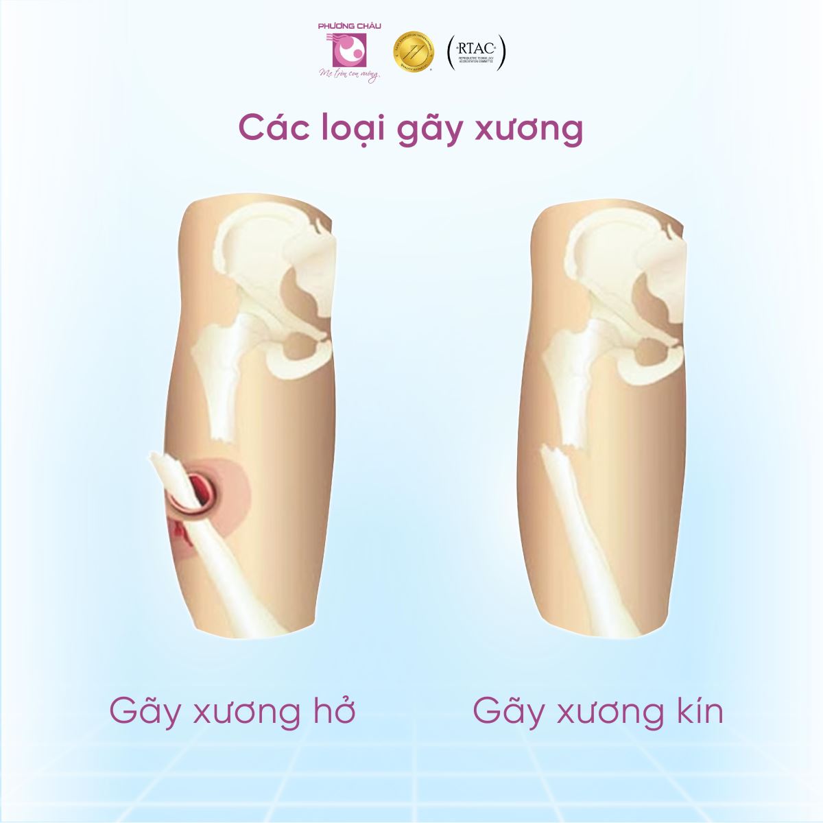 Bó bột thường áp dụng cho gãy xương kín