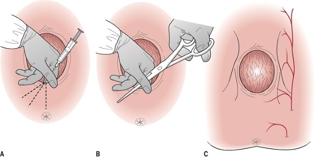 Cắt tầng sinh môn trong sinh nở mang lại nhiều lợi ích cho mẹ bầu