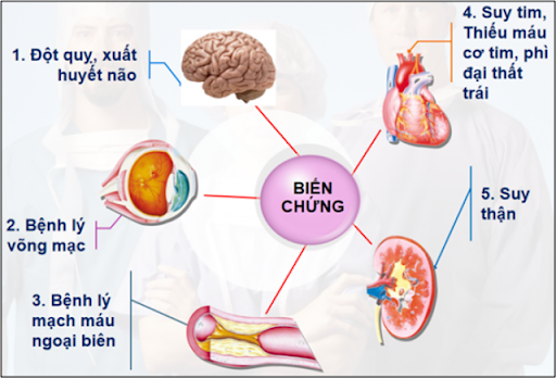 Các biến chứng của bệnh tăng huyết áp