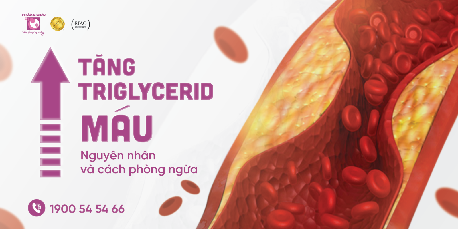 Tăng triglycerid máu cần được phát hiện và điều trị sớm