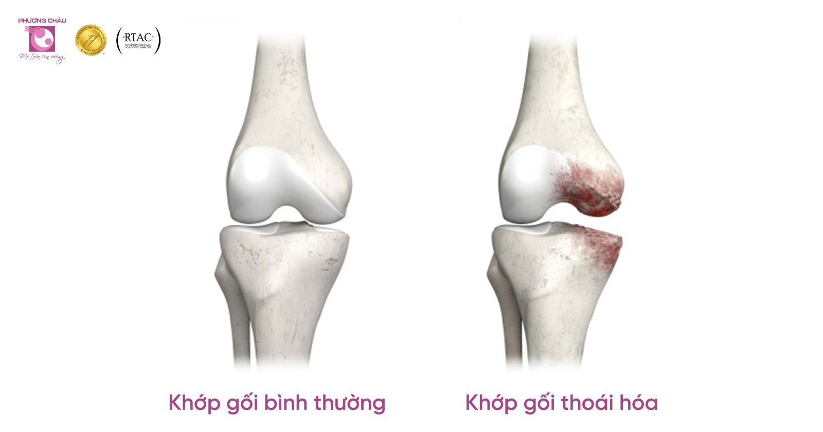 Thoái hóa khớp gối xảy ra khi có sự mất cân bằng giữa quá trình tổng hợp và hủy hoại sụn và xương dưới sụn