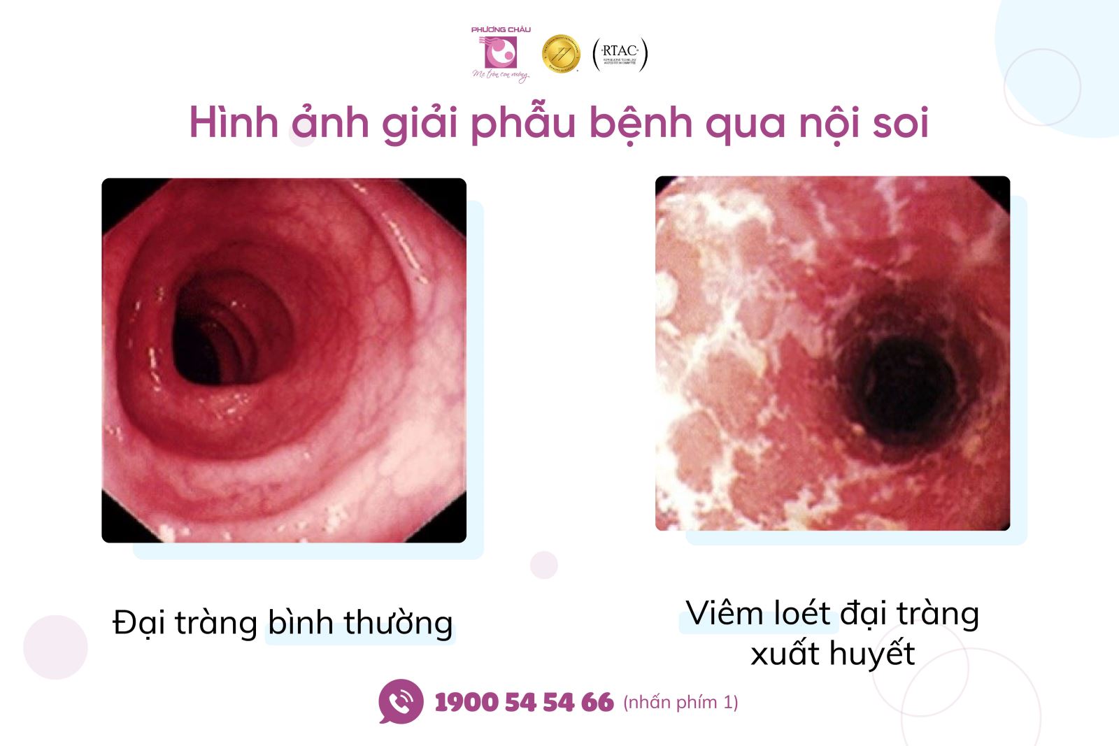 Hình ảnh đại tràng bình thường (trái) và viêm loét đại tràng xuất huyết (phải)