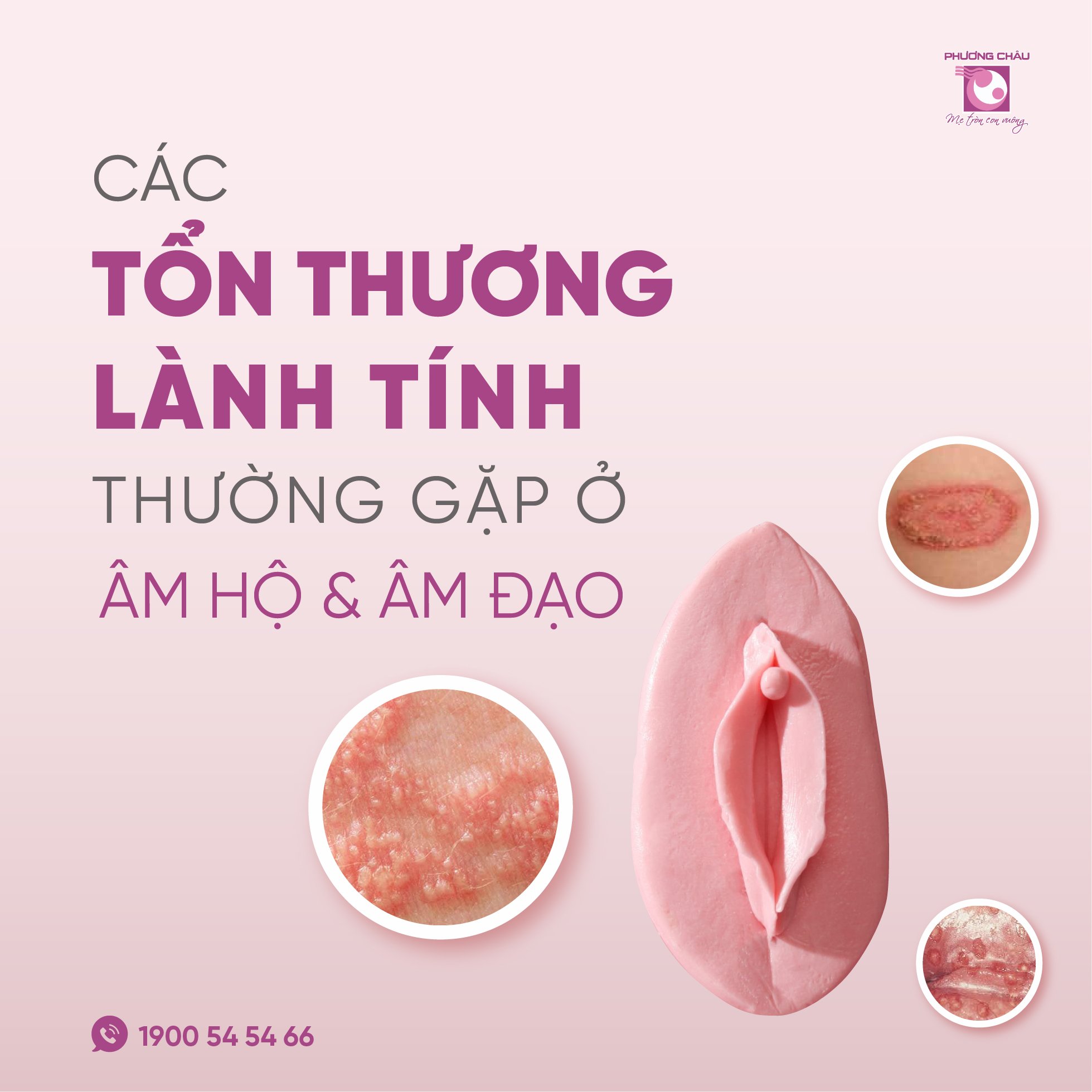 bệnh phụ nữ, giang mai, Herpes, bít màng trinh, vách ngăn âm đạo có vách, vách ngăn ngang âm đạo, phụ khoa bệnh viện phụ sản quốc tế phương châu, cần thơ