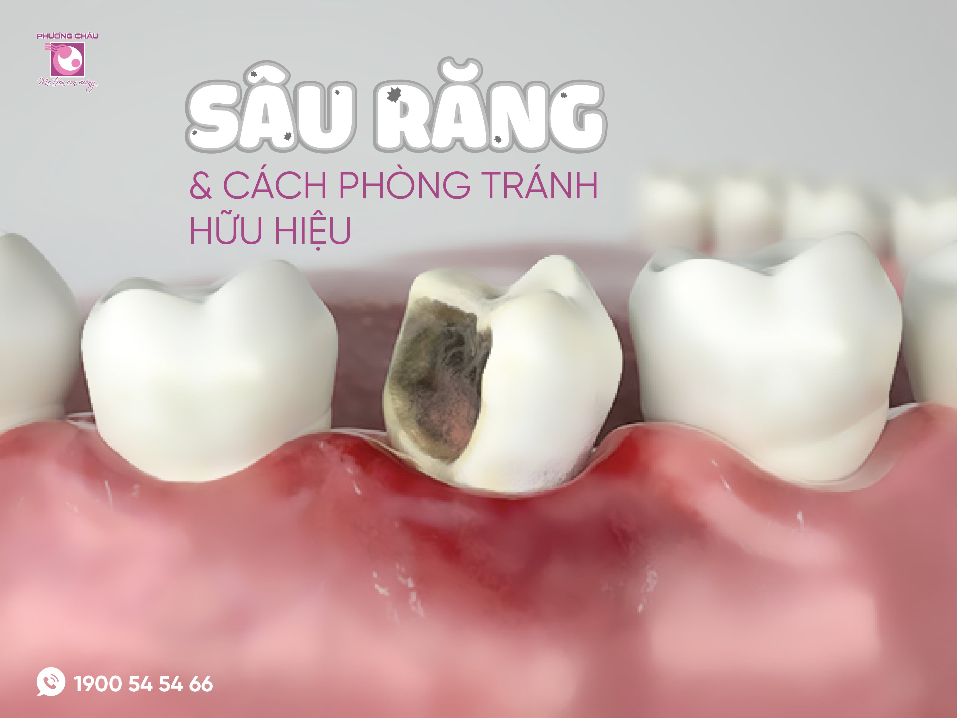 sâu răng, cách phòng tránh, hiệu quả, Đa khoa, răng hàm mặt, Phương Châu