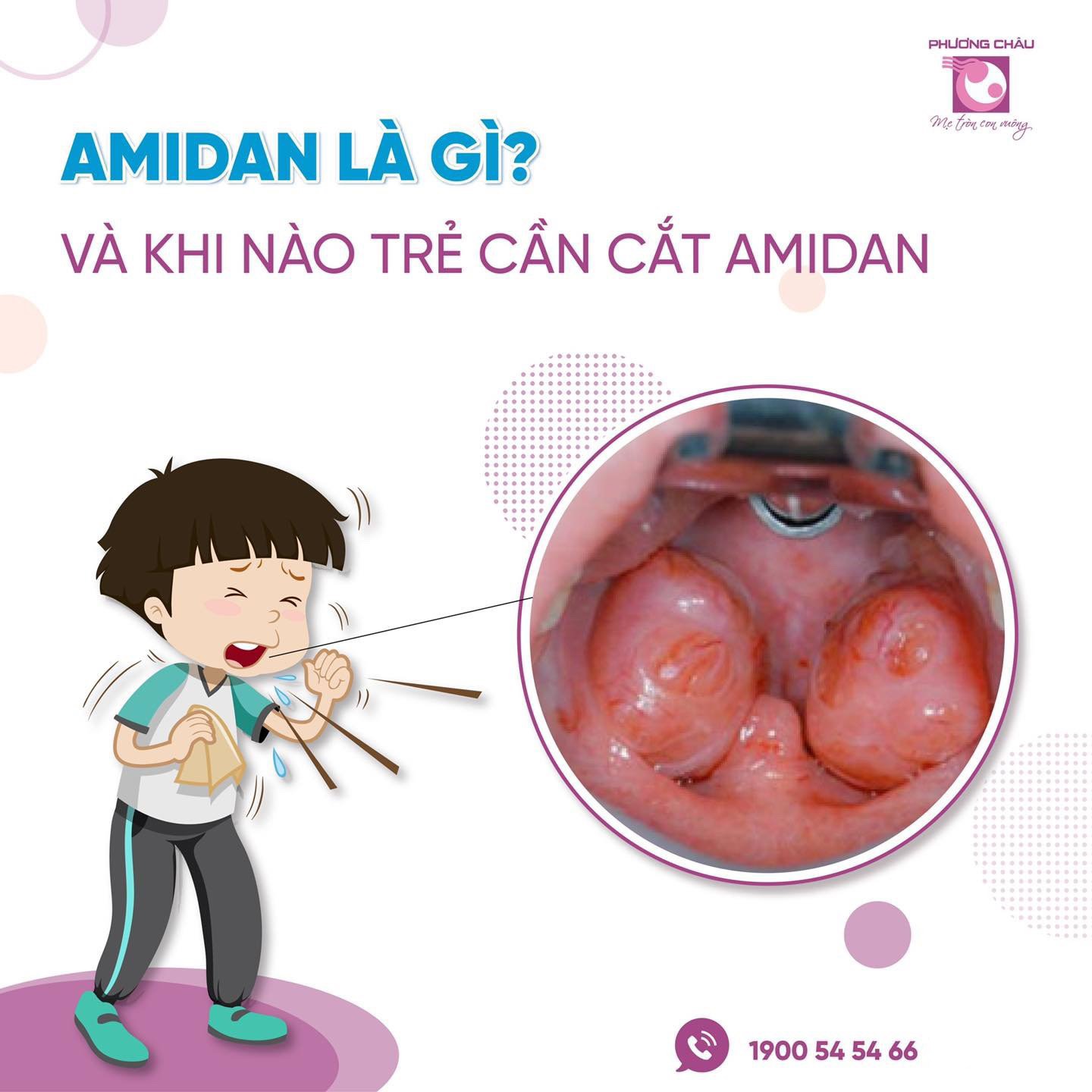 amidan, là, gì, khi nào, cắt, an toàn, hiện đại, Nhi khoa, Phương Châu, chăm sóc, toàn diện