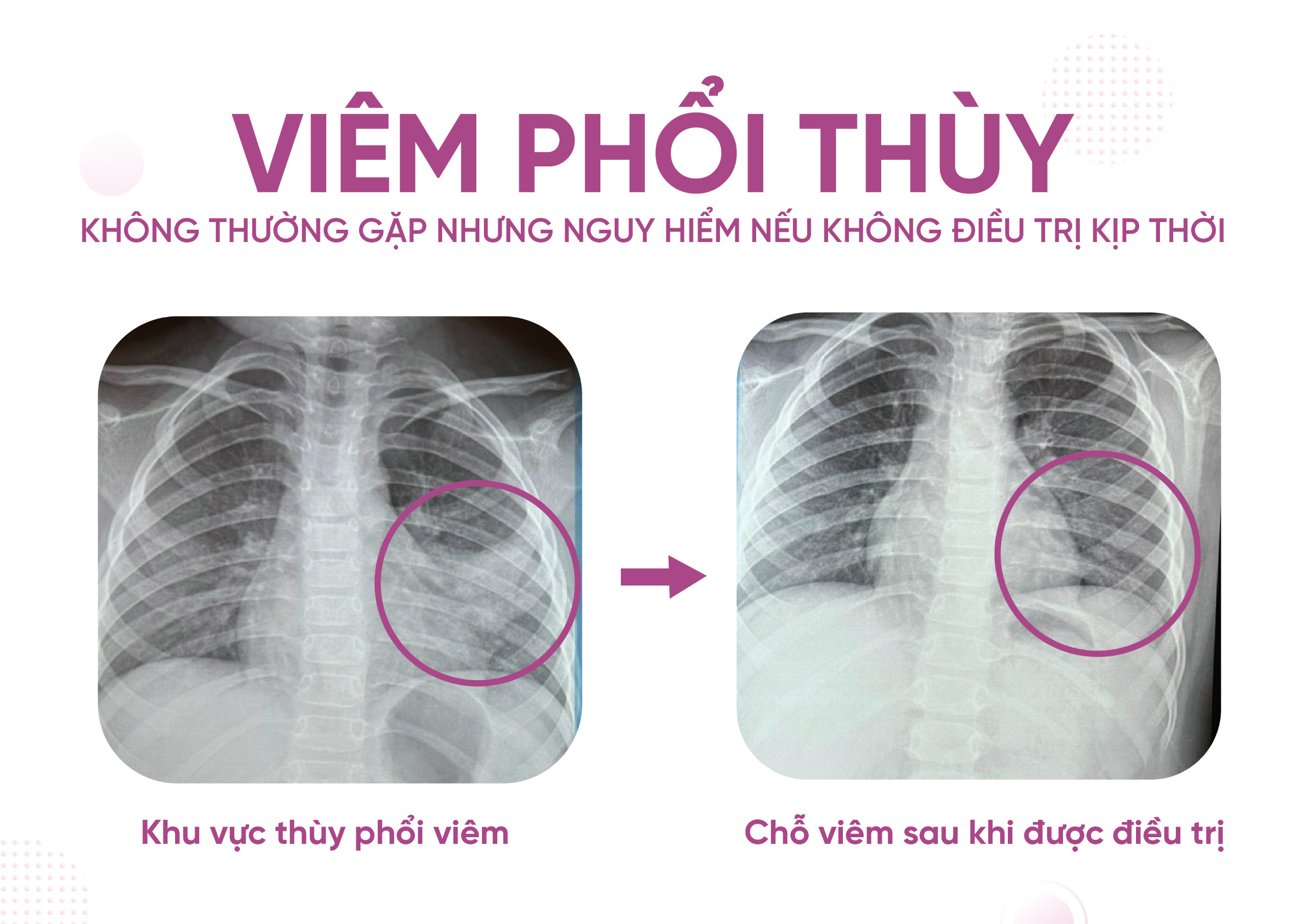 viêm phổi thùy , không thường gặp, biến chứng, nguy hiểm, không điều trị, kịp thời, nhi khoa, phương châu, bệnh viện, quốc tế, jci