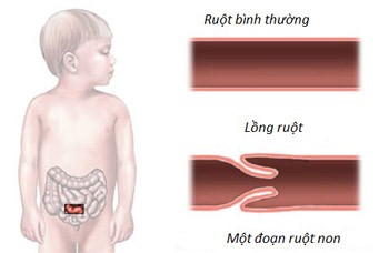 lồng ruột ở trẻ em