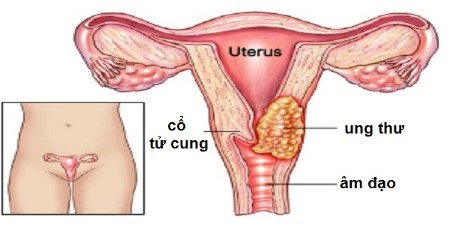 ung thư, cổ tử cung, virus HPV, tìm hiểu, phụ nữ