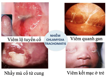 chuyên đề, vi khuẩn, CHLAMYDIA TRACHOMATIS, ảnh hưởng, phụ nữ, mang thai, trẻ em, dược, phương châu