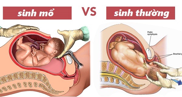 lợi ích sinh thường, lợi ích sinh mổ, vì sao không nên sinh thường, vì sao không nên sinh mổ, phụ sản, bệnh viện quốc tế phương châu, cần thơ