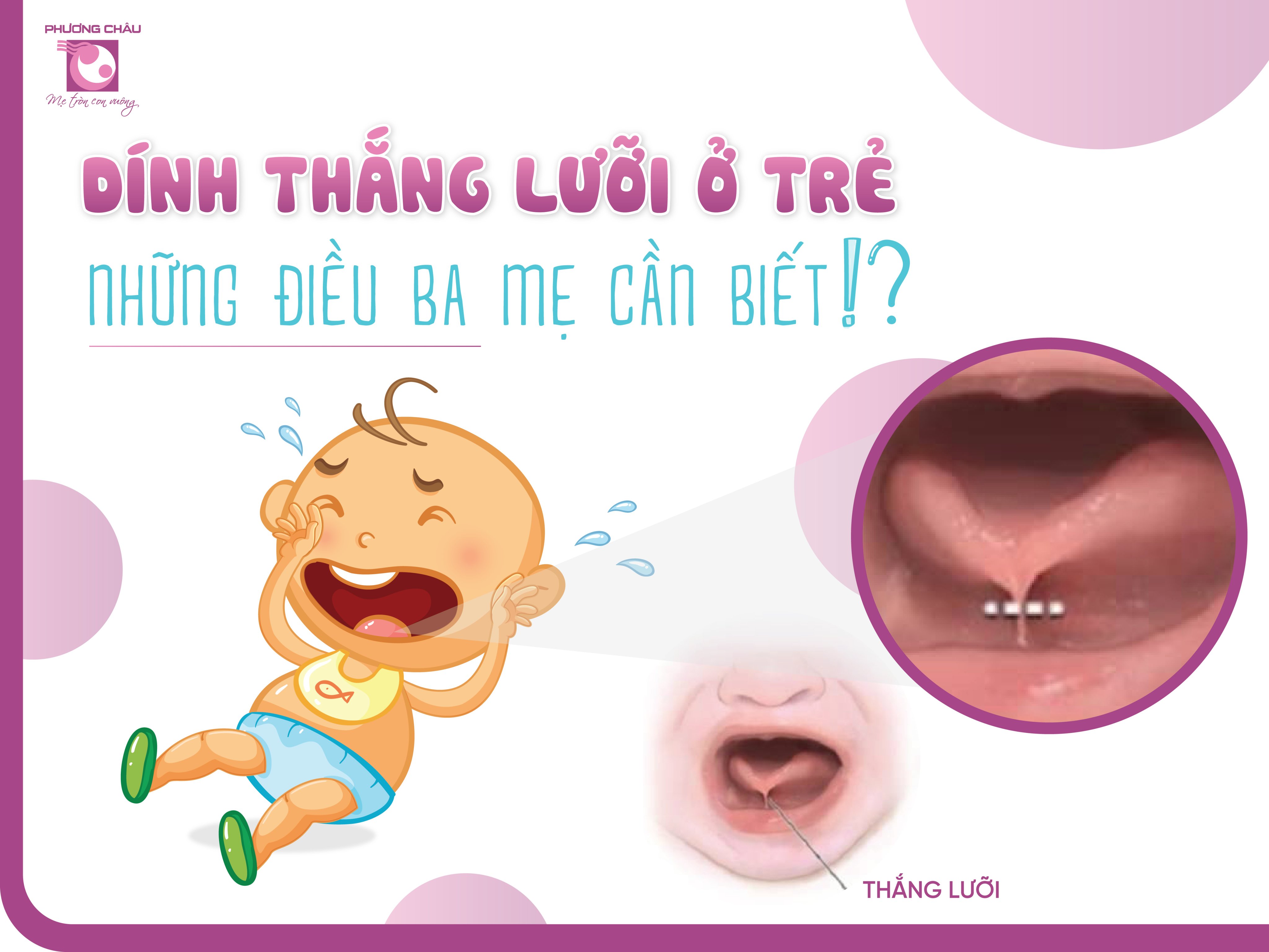 Dính thắng lưỡi, nhận biết và điều trị