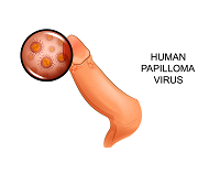 sùi mào gà, mụn cóc, bệnh lây nhiễm, HPV, nam khoa, phương châu, bệnh viện quốc tế