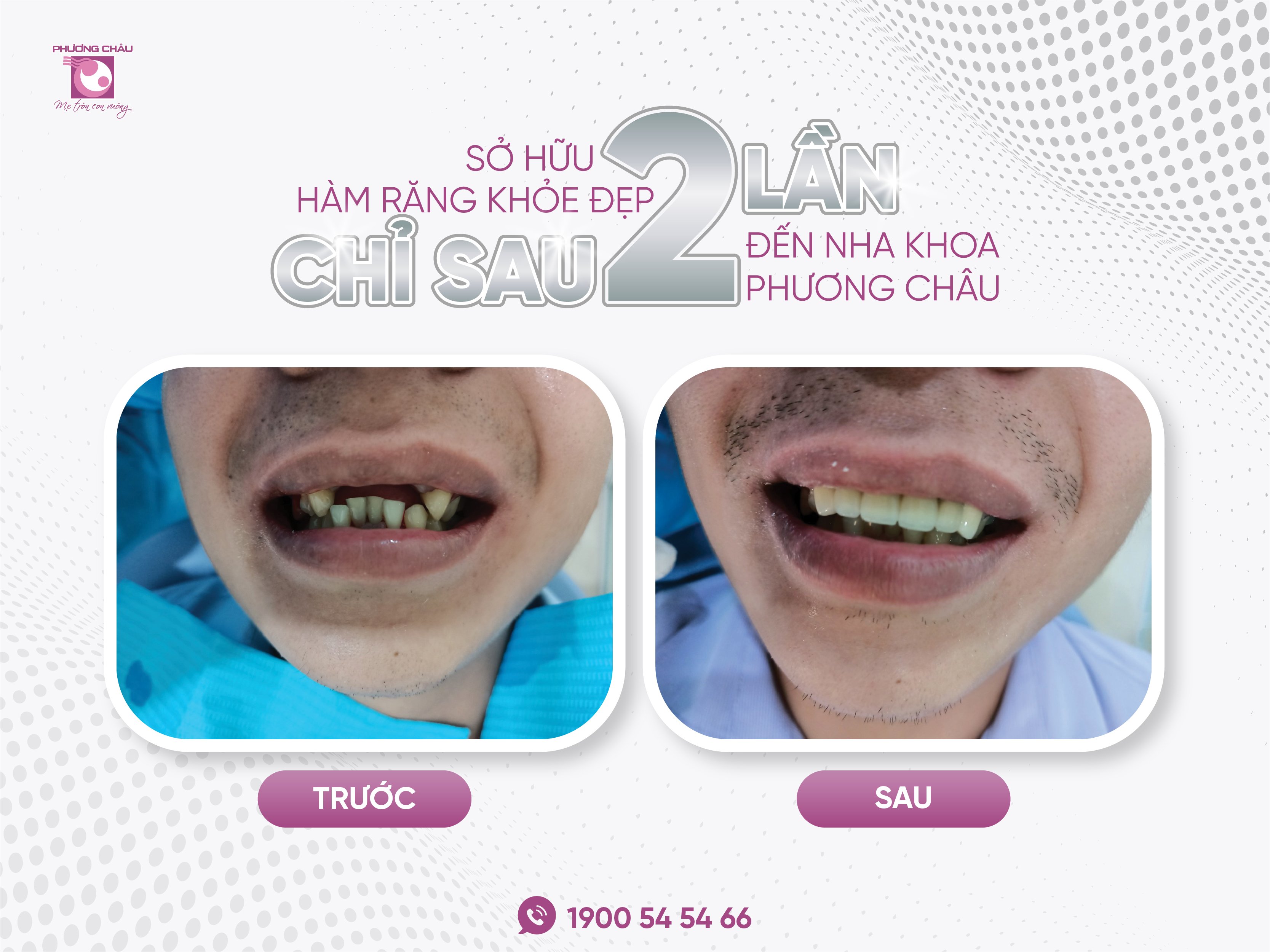 sở hữu, hàm răng, khỏe đẹp, sau 2 lần, Nha khoa, Đa khoa, Phương Châu, phục hình, tháo lắp, cố định