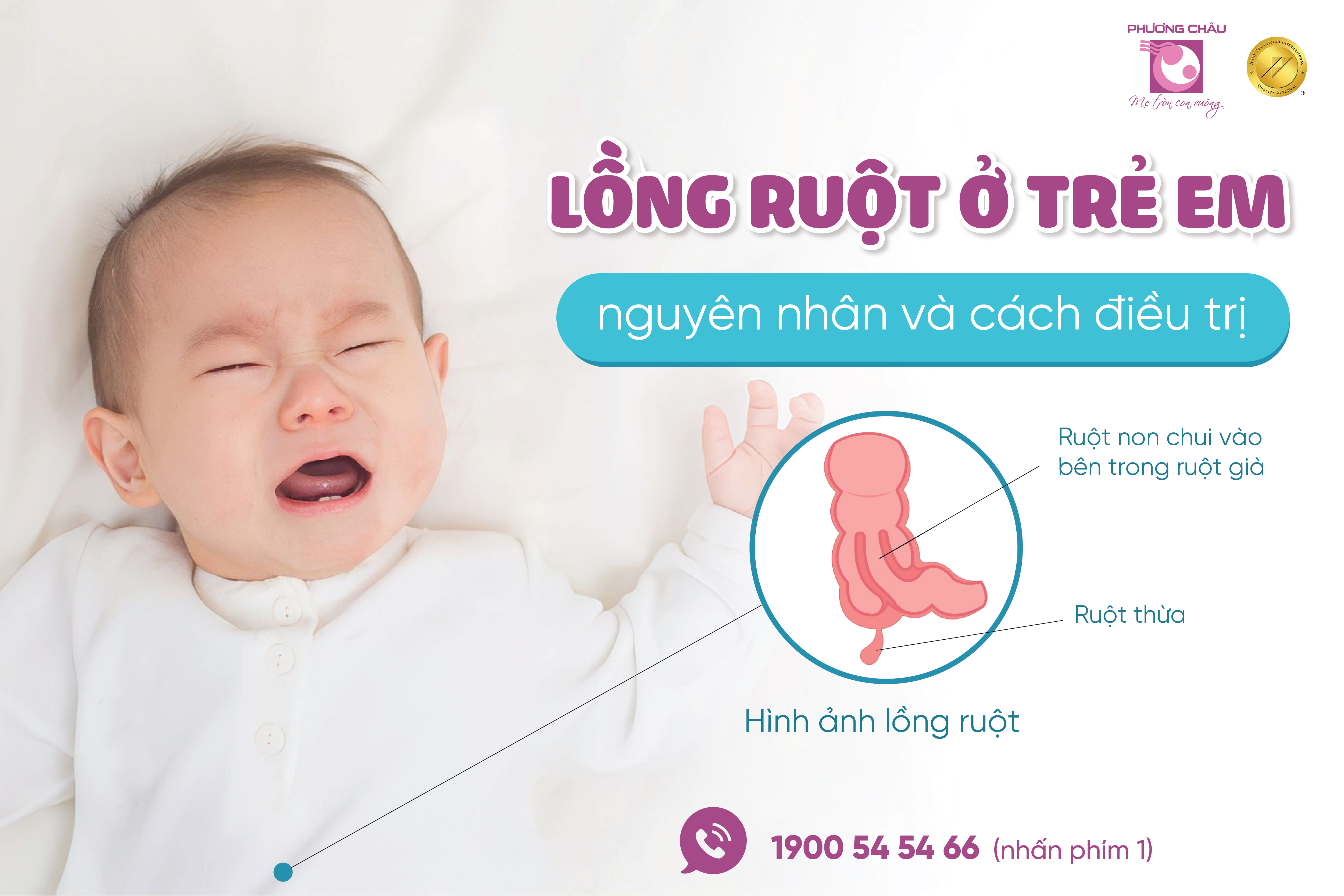 lồng ruột, trẻ em, nguyên nhân, điều  trị, nhi, sơ sinh, phương châu