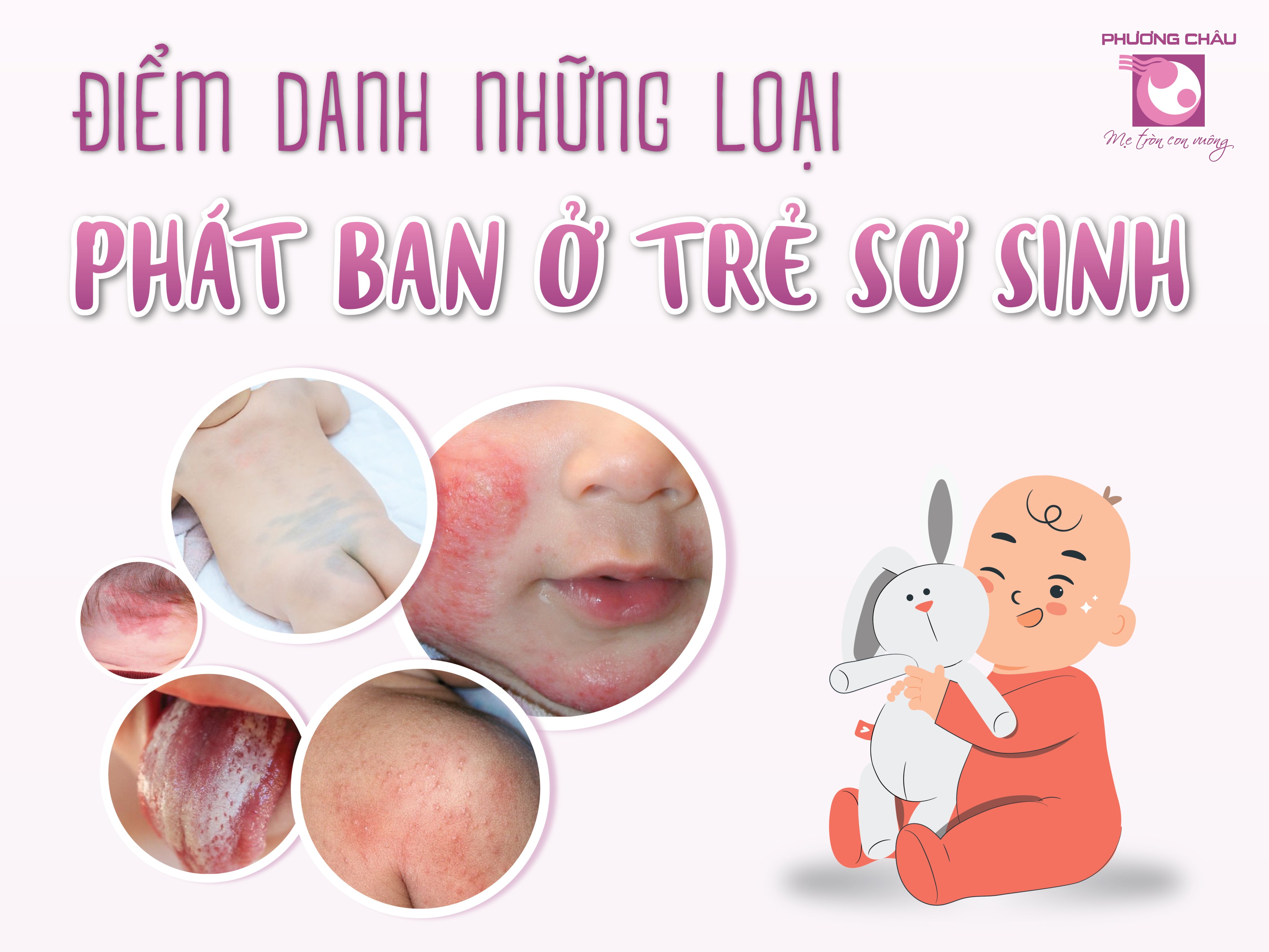 điểm danh, những loại, phát ban, trẻ sơ sinh, Nhi khoa, Phương Châu