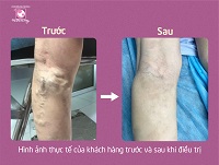 suy giãn tĩnh mạch, phù chân, nặng chân, mỏi chân, khám ở đâu, nguy hiểm không, BS Hoàng, Phương Châu