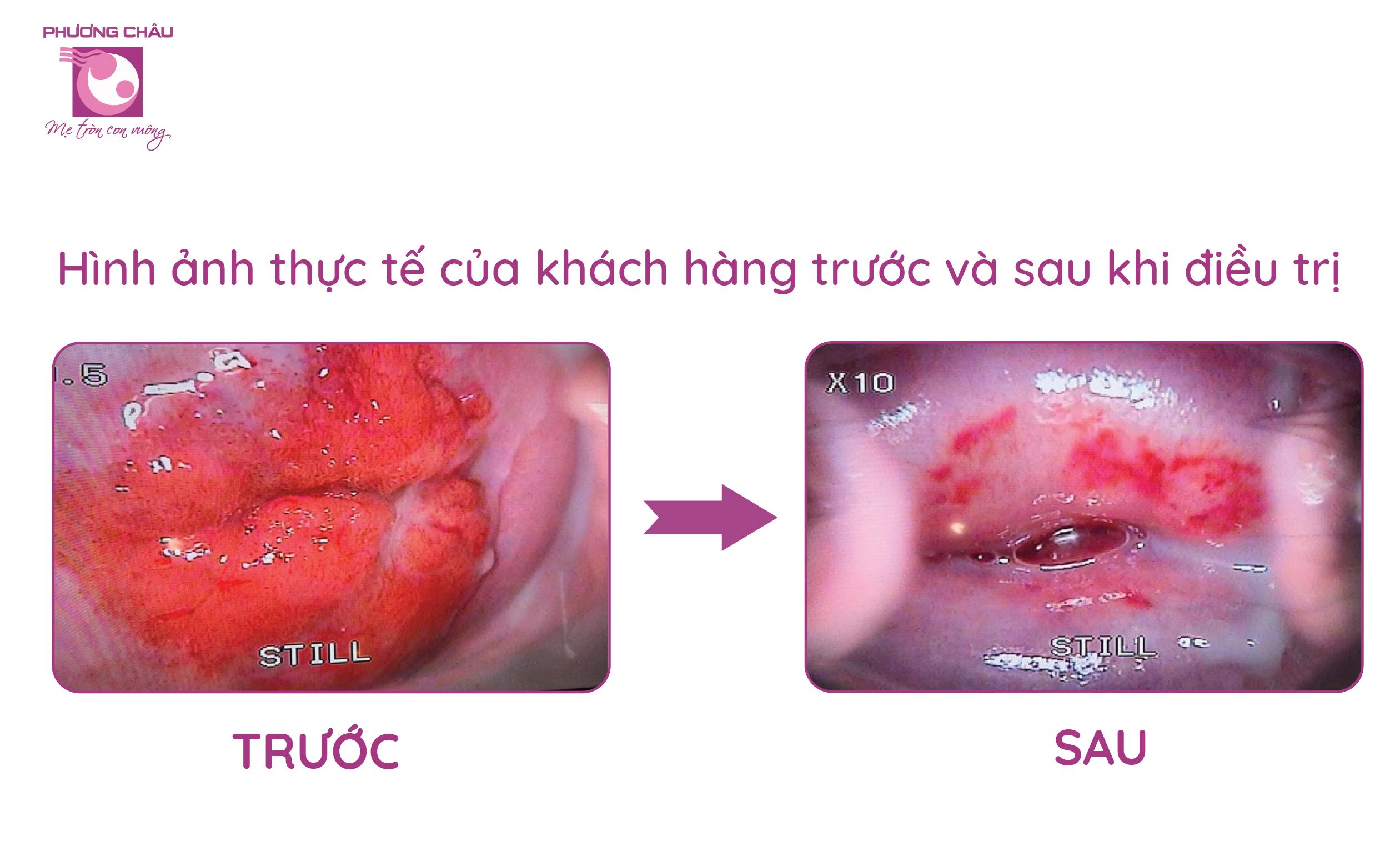 lộ tuyến cổ tử cung, viêm nhiễm, đau rát, ngứa ngáy, khó chịu, có nguy hiểm không, điều trị ra sao, bệnh phụ nữ, bệnh viện phụ sản quốc tế Phương Châu