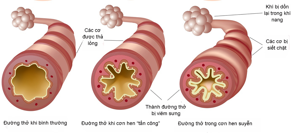 hen, suyễn, nhi sơ sinh, trẻ em, phương châu, bệnh viện