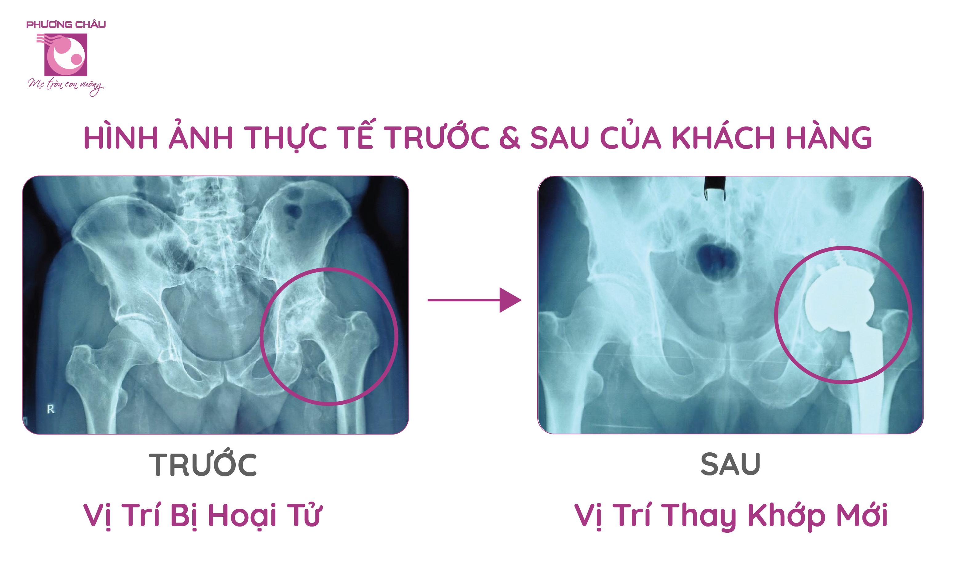 thay khớp háng toàn phần, hoại tử do thoái hóa, Đa khoa Phương Châu, bệnh viện tại Cần Thơ