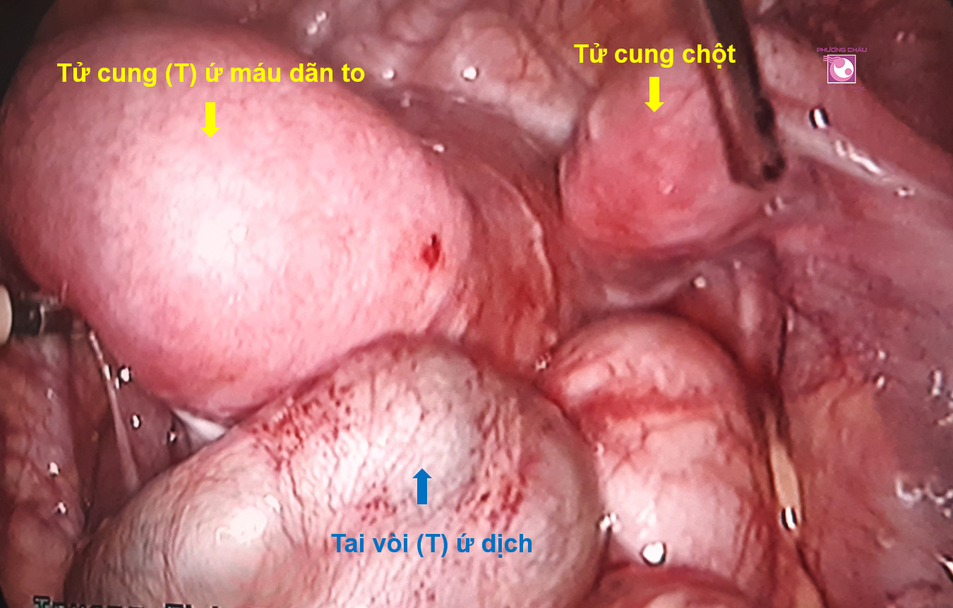  U nang buồng trứng, Tử cung 2 sừng, Ứ dịch lòng tử cung, tắc nghẽn, tử cung dãn to tai vòi trái, Vách ngăn ngang âm đạo gây bít tắc cổ tử cung, Thận phải duy nhất