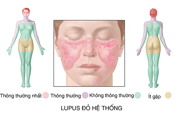 lupus ban đỏ, biến chứng thận, bệnh nguy hiểm sau sanh, phù toàn thân kiểu thận, huyết áp tăng dần, đạm niệu, hội chứng thận hư