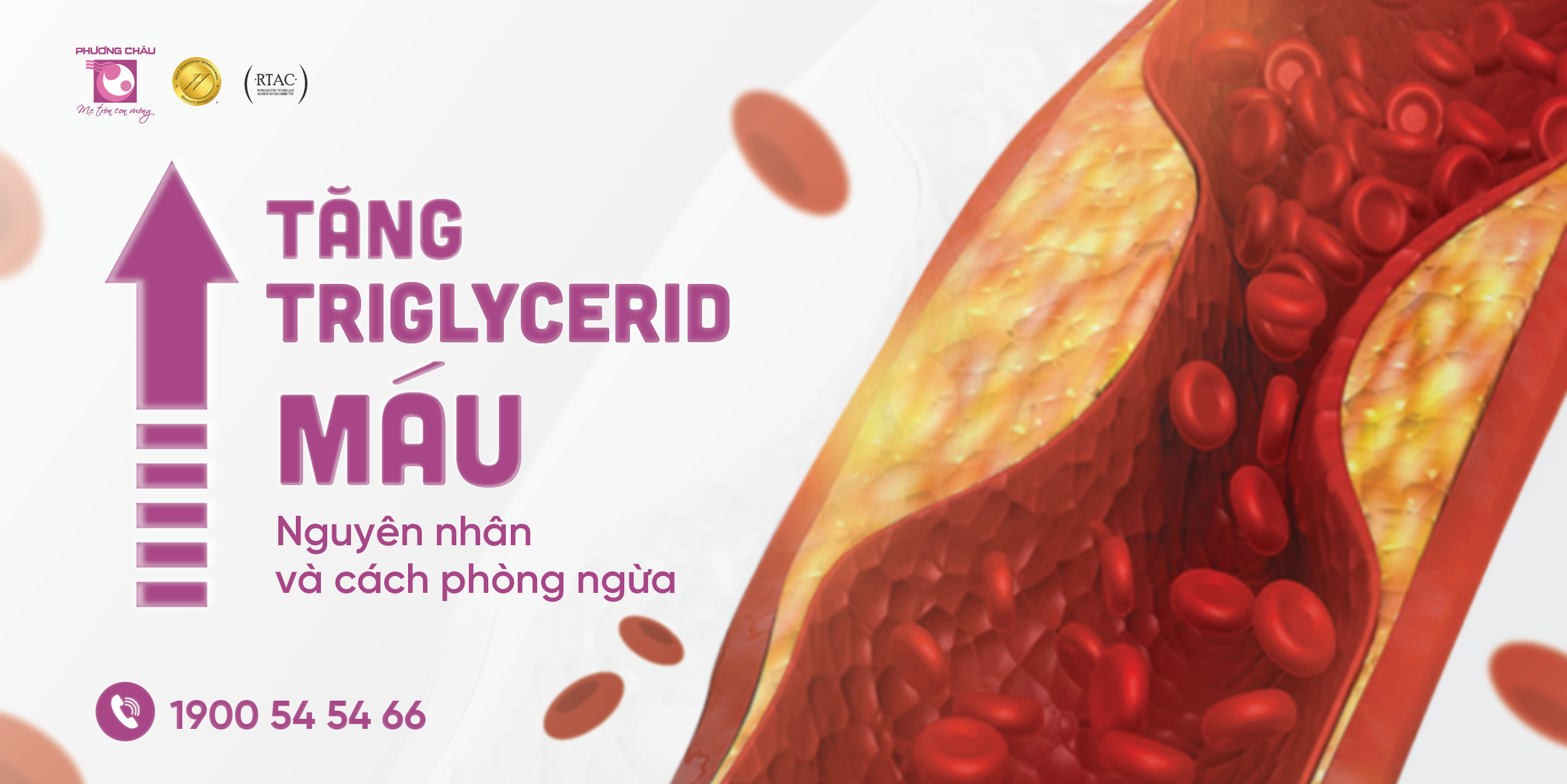 Tăng triglycerid máu thường gặp ở người béo phì, rối loạn chuyển hóa... Nếu không kịp thời điều trị có thể gây nhiều biến chứng nguy hiểm.