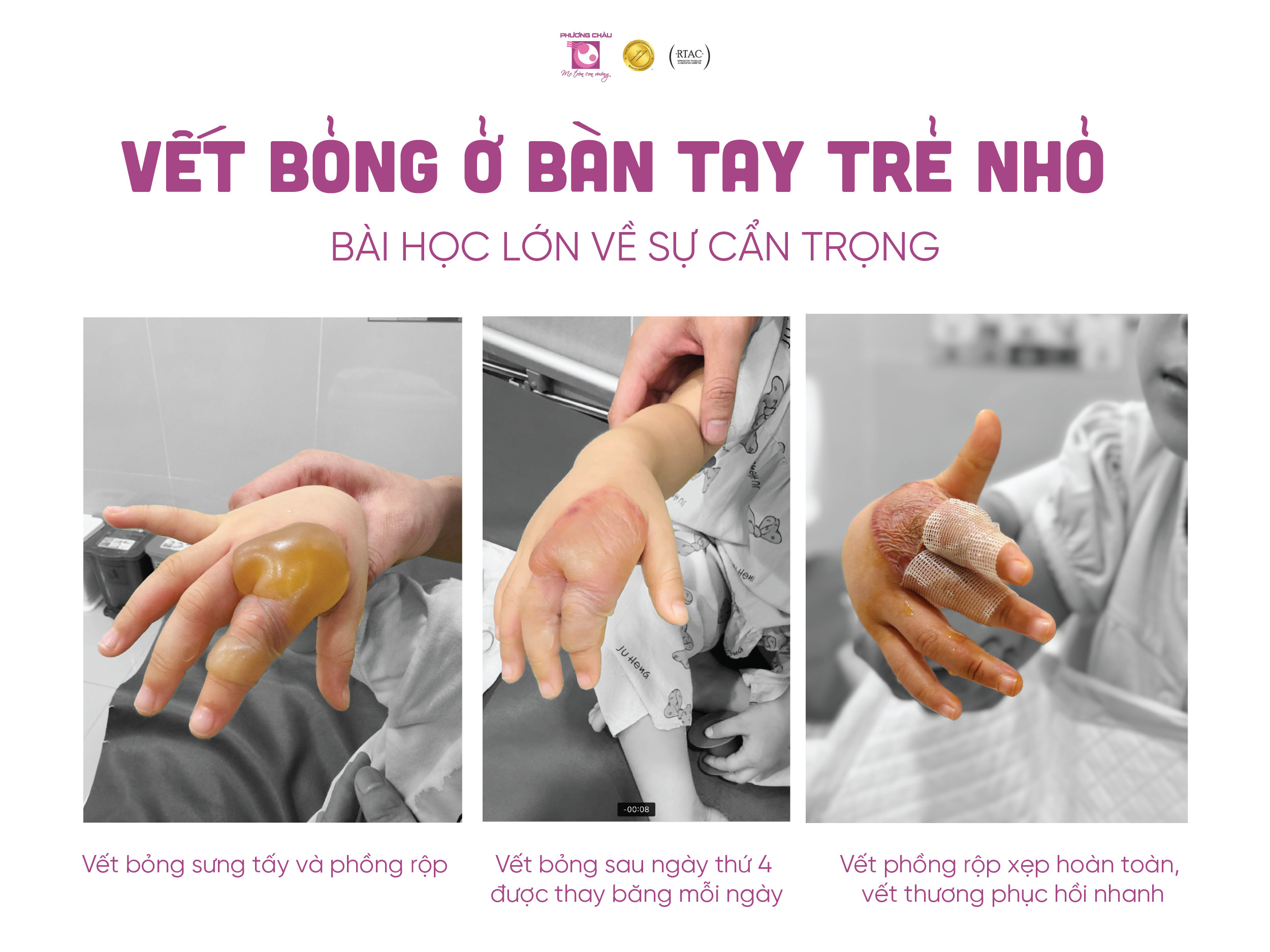 vết bỏng, bàn tay, trẻ nhỏ, bài học, sự cẩn trọng, nhi khoa, phương châu